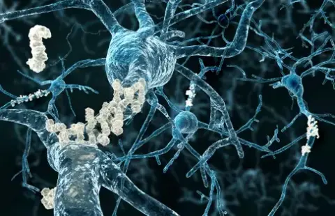 Az arginin és az Alzheimer-kór