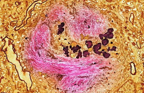 Újfajta hatóanyag segíthet az Alzheimer-kór lelassításában