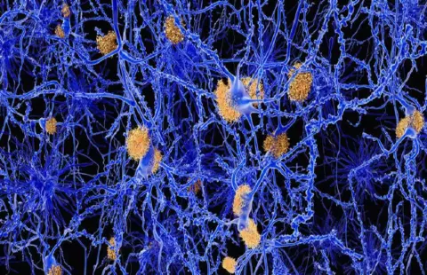 Villogó fényekkel kezelnék az Alzheimer-kórt