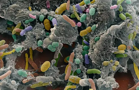 A mikrobiom révén válhat kezelhetővé a bélgyulladás