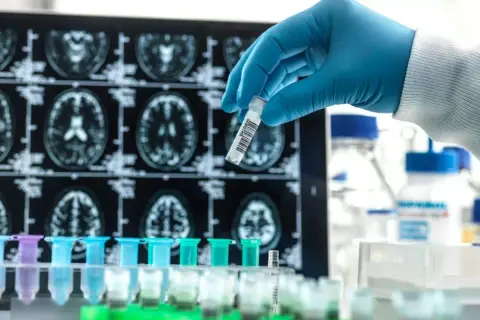 Hatásosnak tűnik, de nem csodaszer az új Alzheimer-gyógyszer