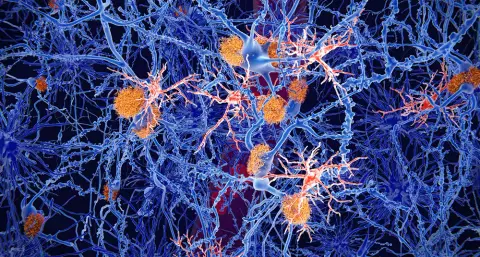 Közzétették az eddigi legjobbnak tűnő kísérleti Alzheimer-gyógyszer adatait