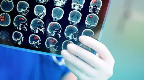 Ígéretes Alzheimer-kór elleni vakcinát fejlesztenek Japánban